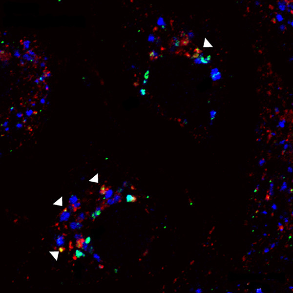 NSCLC cell line H1650 immunostained using DSHB antibody H4A3 anti-LAMP-1, human (blue). PMID: 19948031, Fig. 2A.